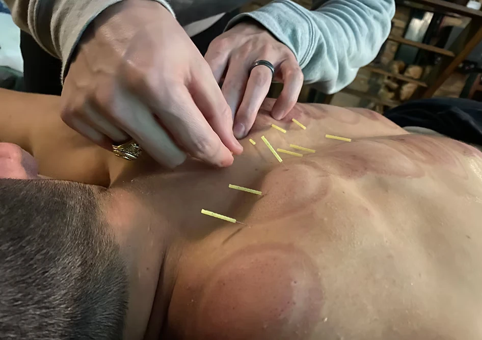 Dry Needling